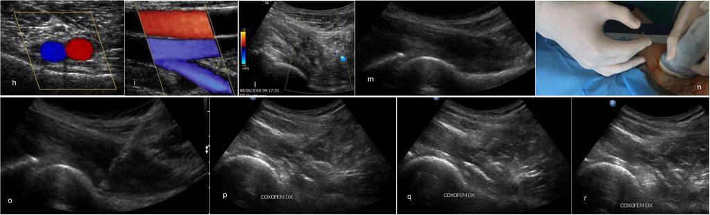 Infiltrazione coxofemorale 6 - US Puntura anca e vasi - Dott. Vincenzo Pipitone - Villa Mafalda